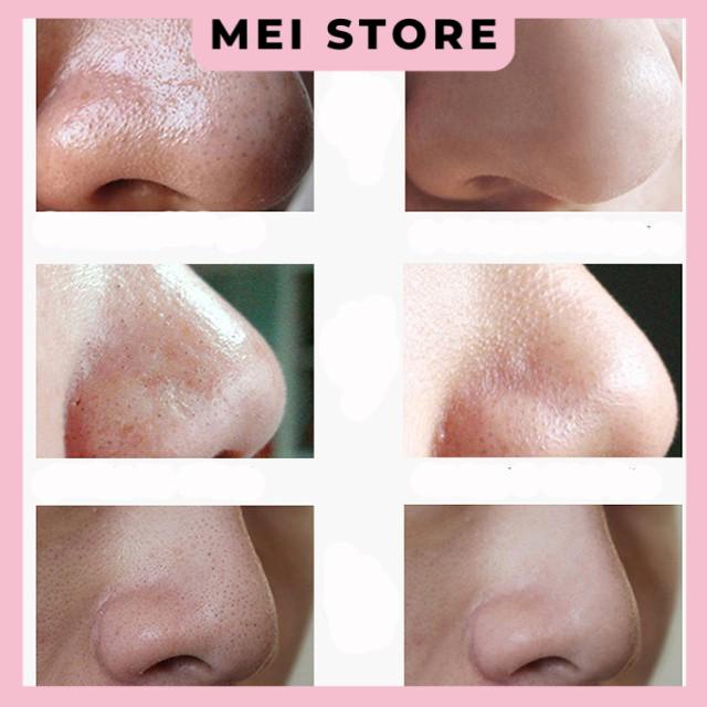 Miếng Gel lột mụn mũi than tre hoạt tính Images Activated carbon