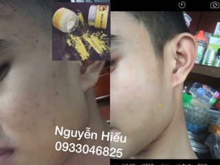KEM NGHỆ NẾP ĐỎ