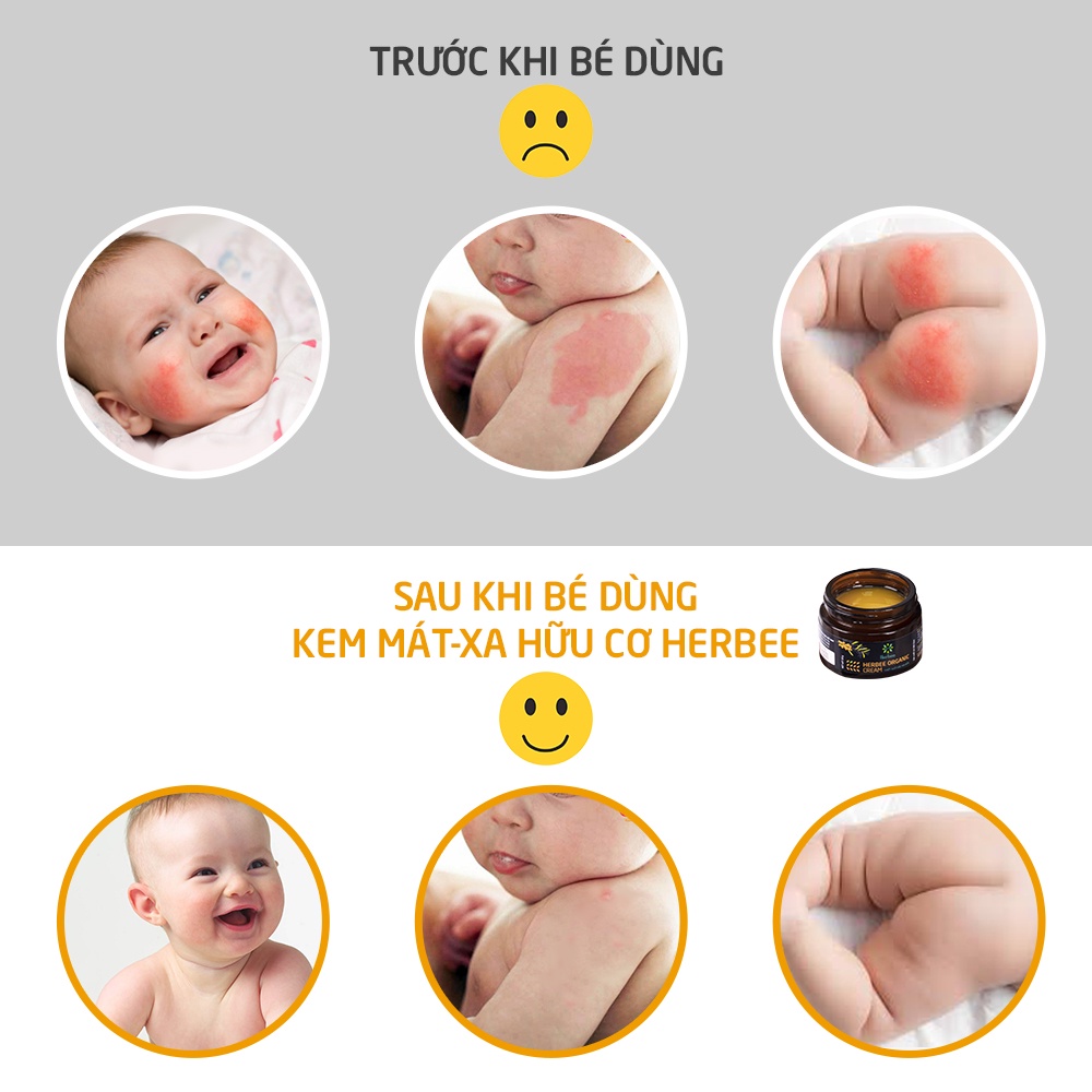 Kem Rạn Da Herbee 50g, Cung Cấp Độ Ẩm Cho Da Khô, Giúp Duy Trì Sự Đàn Hồi Và Săn Chắc Cho Mẹ Bầu, Phụ Nữ Sau Sinh