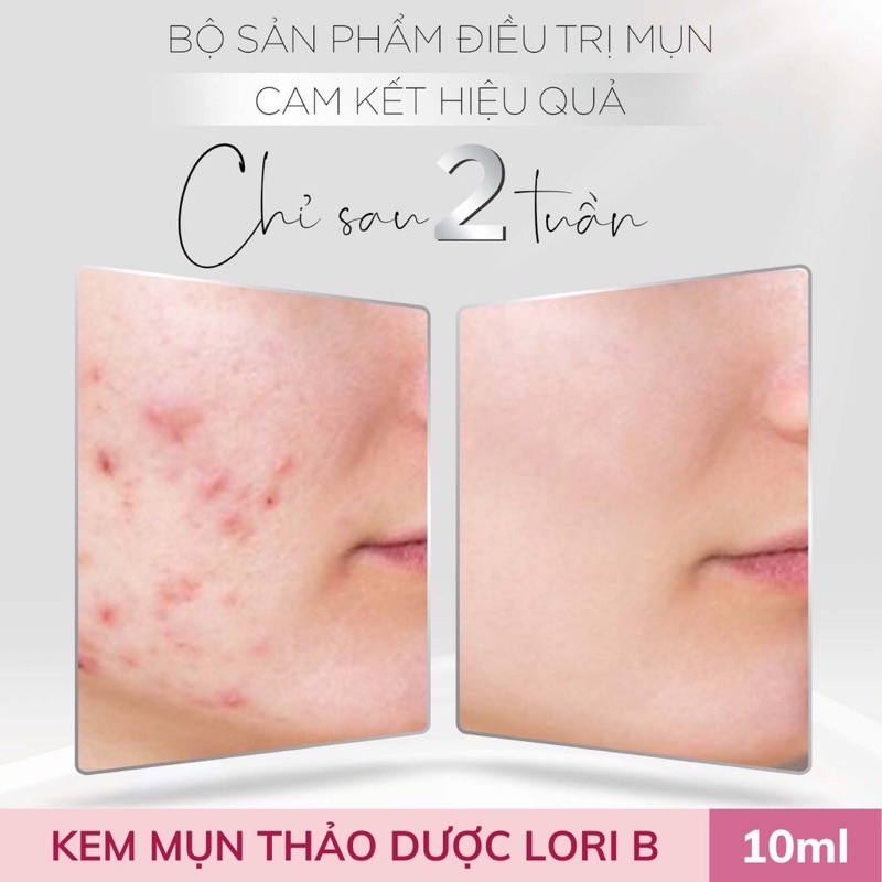 Kem mụn LoriB