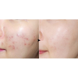 Gel Dán Giảm Mụn Prreti Second Skin Patch 10g