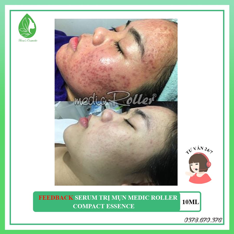Serum mụn Medic Roller | BigBuy360 - bigbuy360.vn