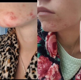 Chấm mụn 𝐁𝐔𝐅𝐅𝐄𝐑𝐈𝐍𝐆 𝐋𝐎𝐓𝐈𝐎𝐍 của 𝐌𝐀𝐑𝐈𝐎 𝐁𝐀𝐃𝐄𝐒𝐂𝐔