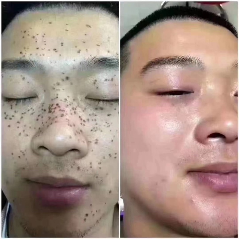 Kem tẩy nốt ruồi chấm nám tàn  nhang