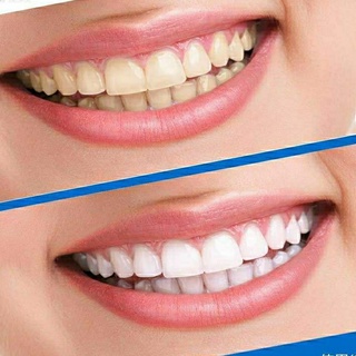 Hộp 7 miếng dán trắng răng 3D white