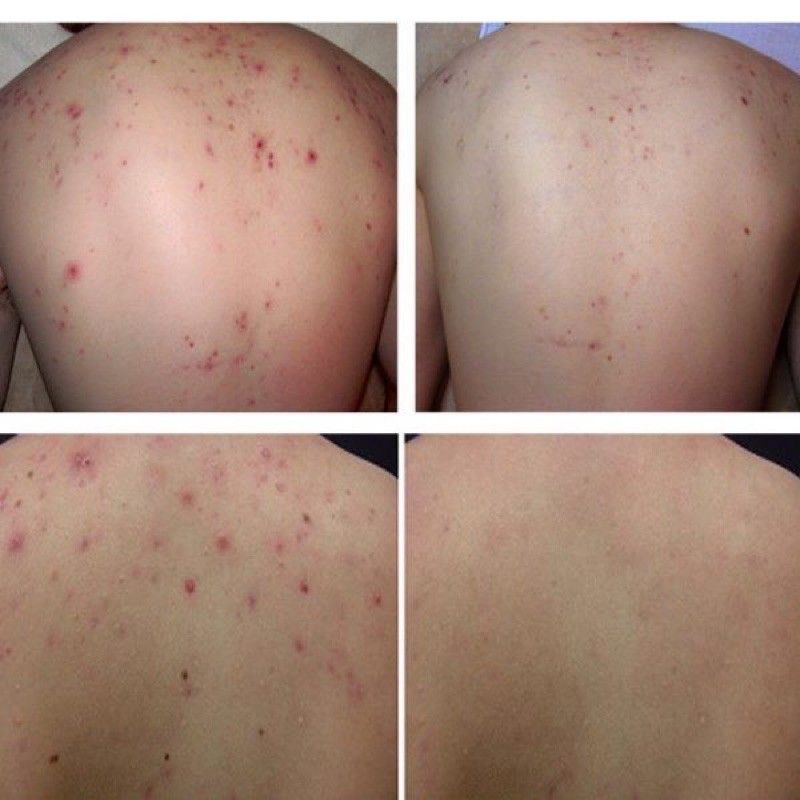 Xà Phòng Giảm Mụn Lưng Nga - Soap giảm mụn cơ thể Nga - Soap mụn lưng