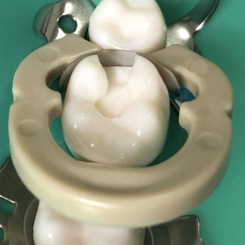 Đai tách kẽ răng kèm vòng kẹp và vòng tách bằng resin