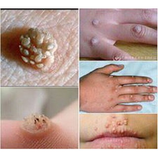 Combo 5 hộp miếng dán trị mụn cóc, mụn cơm, mắt cá chân
