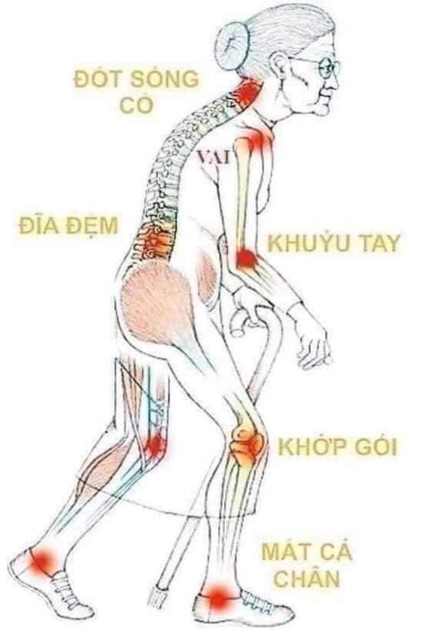 Bộ đôi cao xoa bóp+ cao uống xương khớp ( thần dược cho các bệnh về xương)