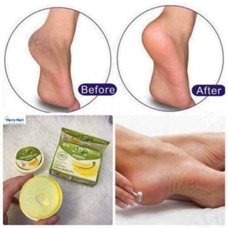 Combo 1 lố kem nứt gót chân chuối thái lan