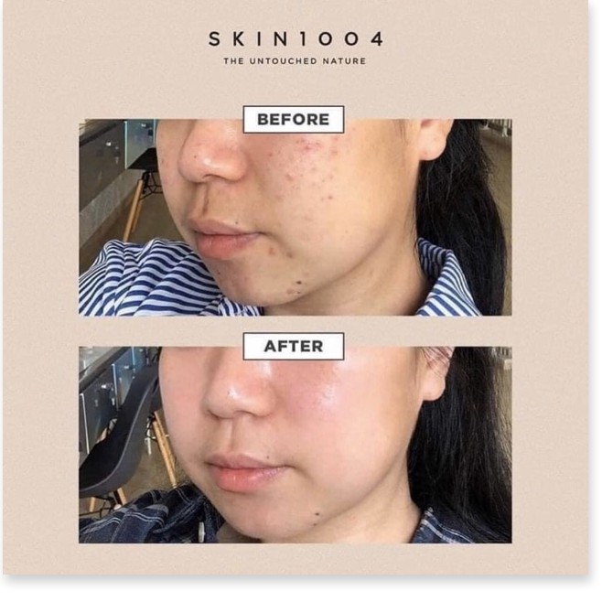 [Mã giảm giá] | SKIN 1004 | Bộ Sản Phẩm Rau Má Cho Da Mụn Madagascar Centella