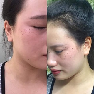 Chấm nốt ruồi tàn nhang