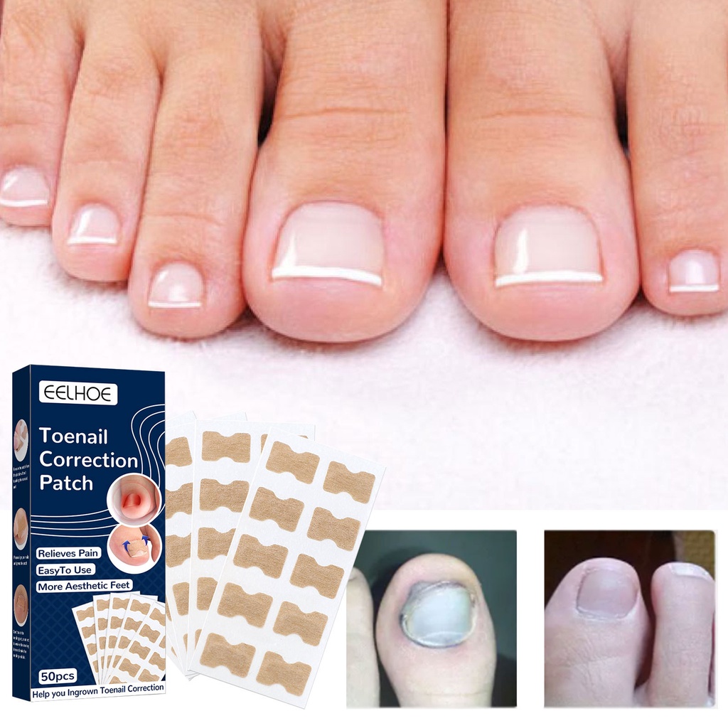 Miếng Dán Chỉnh Sửa Móng Chân Khỏe Mạnh Phù Hợp Cho Điều Chỉnh Móng Chân Bị Đau Chân