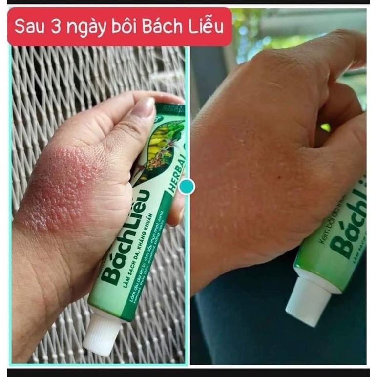 Kem Bôi Da Thảo Dược Bách Liễu 15g