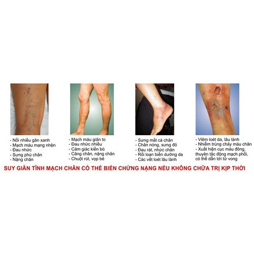 Kem bôi trị suy giãn tĩnh mạch Caruso's Vein 75g