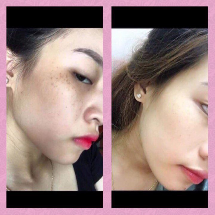💗 MỚI 💗 Hết Nám Tàn Nhang Lâu Năm Nhờ Serum Pukel Plus