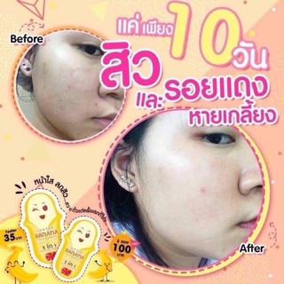 🍌  MẶT NẠ Ủ CHUỐI ĐẨY CỒI MỤN THÁI LAN 🇹🇭