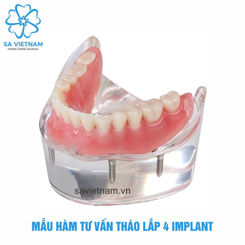 Mẫu tư vấn tháo lắp 2 implant, 4 implant - Hàm tư vấn nha khoa, Mẫu tư vấn nha khoa