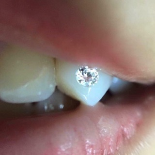 30 viên đá gắn răng