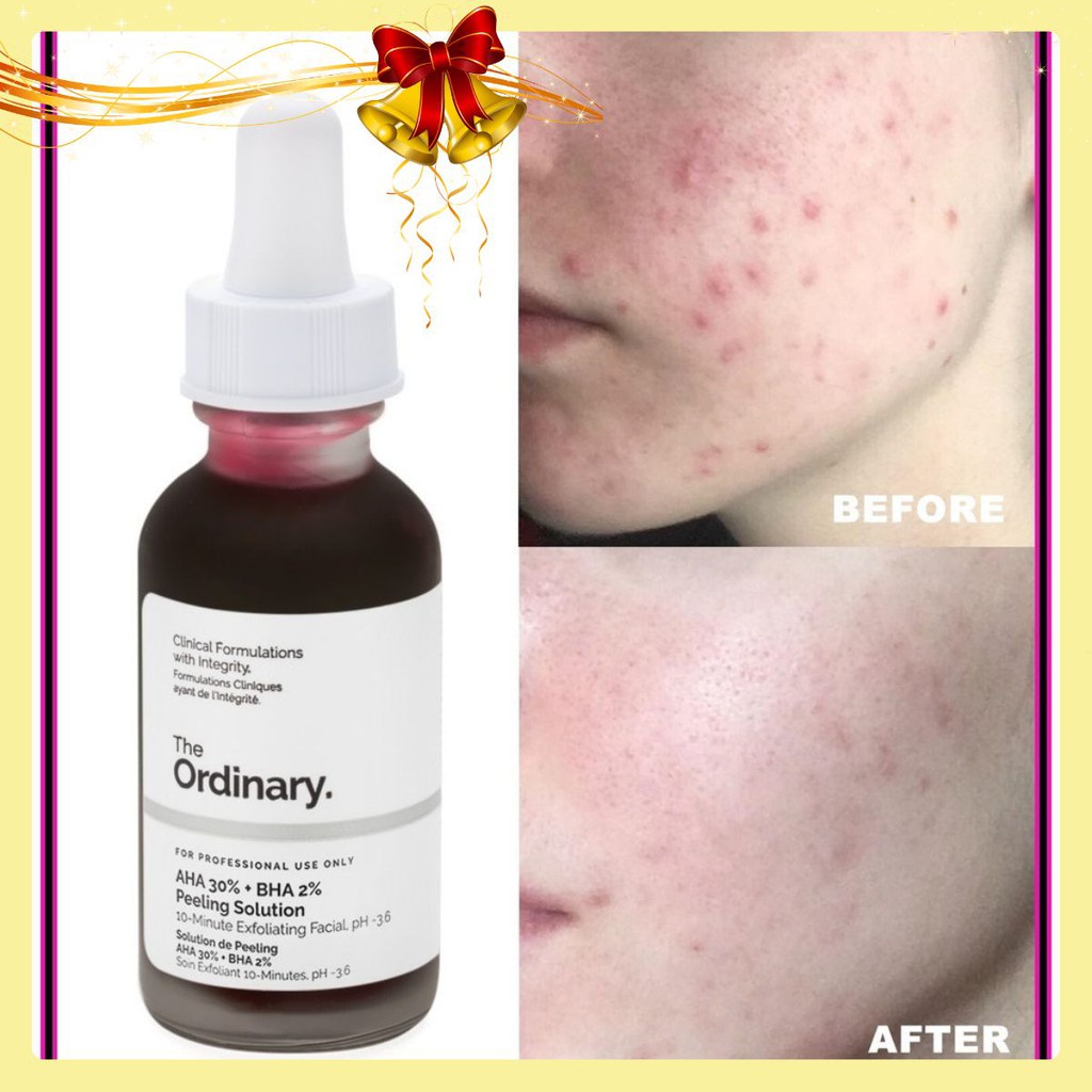 The Ordinary AHA 30% + BHA 2% Peeling Solution Tẩy Tế Bào Chết Hóa Học