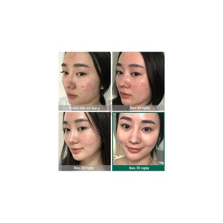 Bộ dưỡng trị mụn "thần kỳ" some by mi miracle travel kit