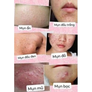 serum mụn (handmade)