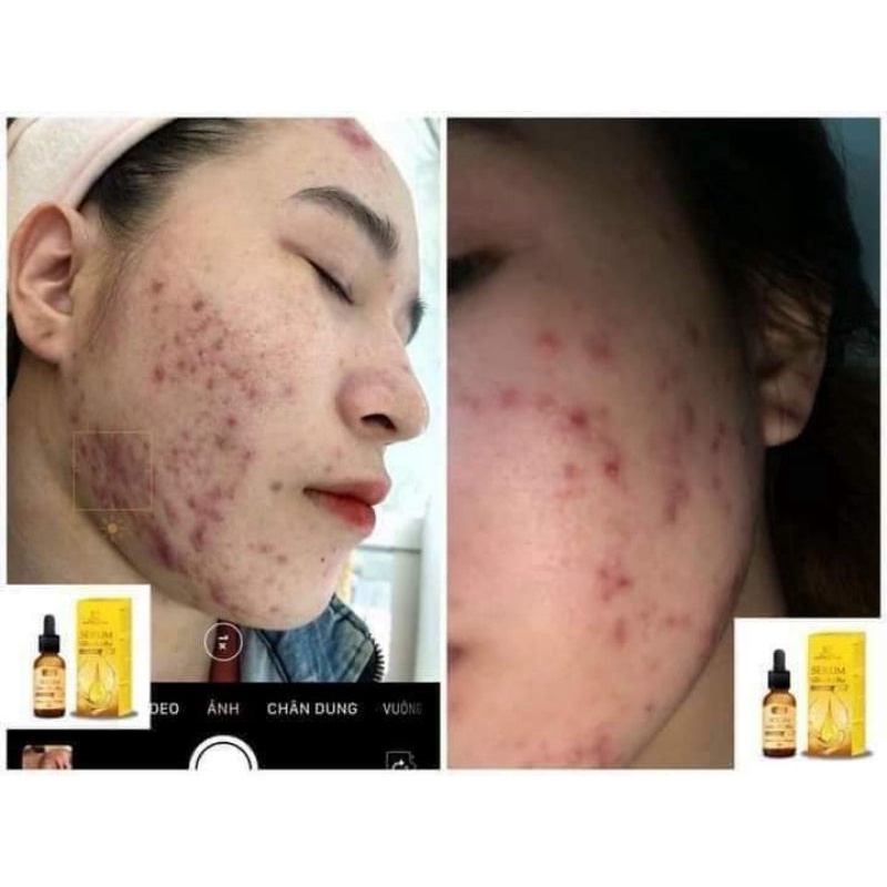 SERUM MỤN COLLEGEN X3,MP ĐÔNG ANH CHÍNH HÃNG | BigBuy360 - bigbuy360.vn