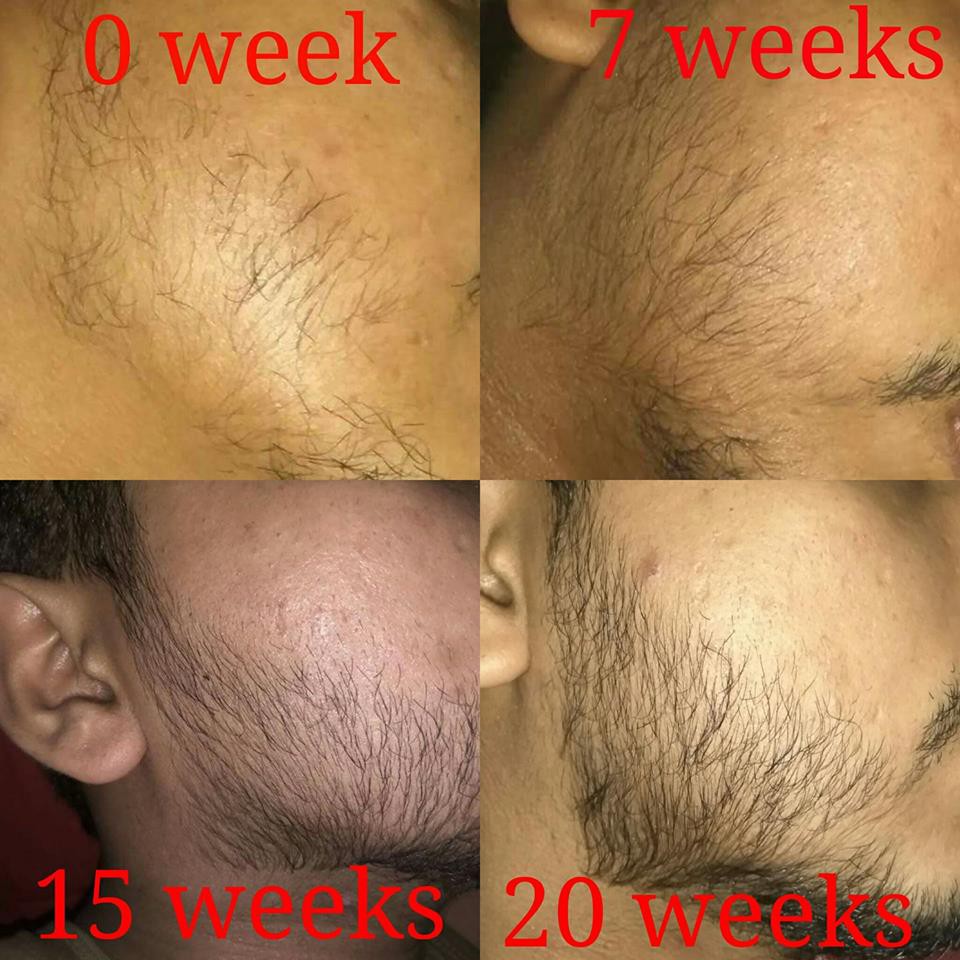 Minoxidil 5% - Dầu duỡng râu tóc - Kích thích mọc râu, nuôi tóc | BigBuy360 - bigbuy360.vn