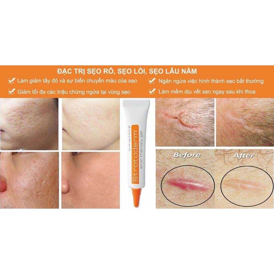 Kem Xóa Sẹo Thâm / Rỗ / Lồi / Lõm Strataderm 10g - Gel Hỗ Trợ Giảm Sẹo Ngăn Ngừa Sẹo Xấu