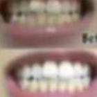 Combo 14 miếng (7 gói/7 ngày) dán trắng răng Crest 3D White Whitestrips loại Professional Effects - Mỹ