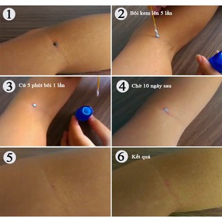 Kem xóa nốt ruồi POOLA