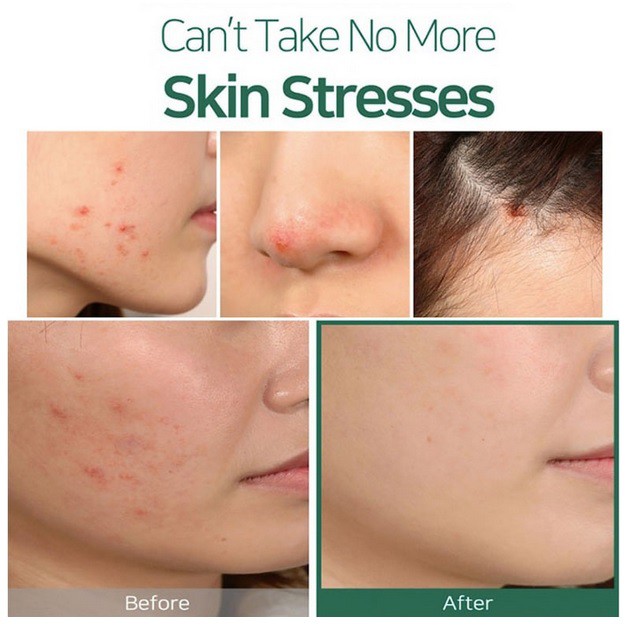 Tinh Dầu Tràm Trà Some By Mi 30 Days Miracle Tea tree Clear spot oil | BigBuy360 - bigbuy360.vn