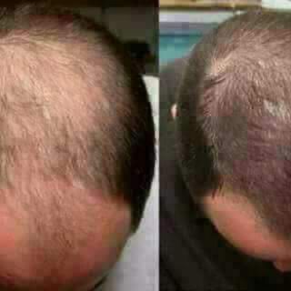 TINH DẦU XỊT BƯỞI MỌC TÓC