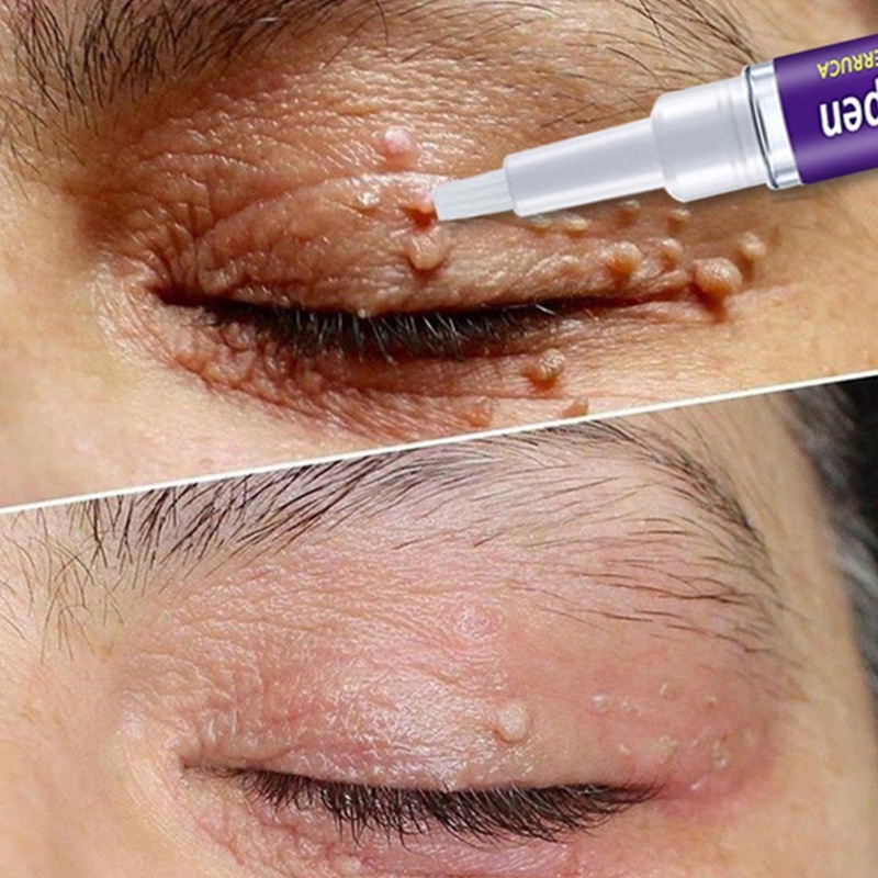 Bút Hỗ Trợ Giảm Mụn Thịt Thừa Cho Cơ Thể