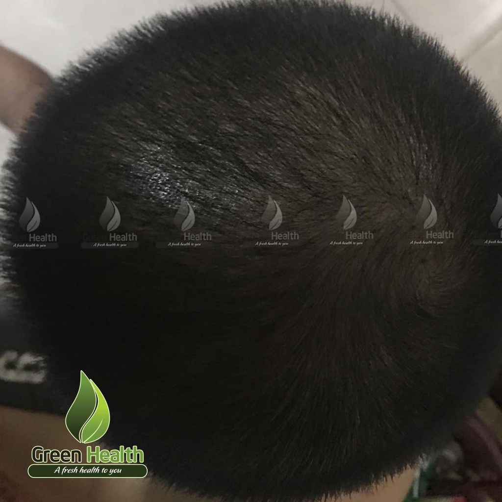 Tặng LCLT- COMBO Mọc tóc Morr F5