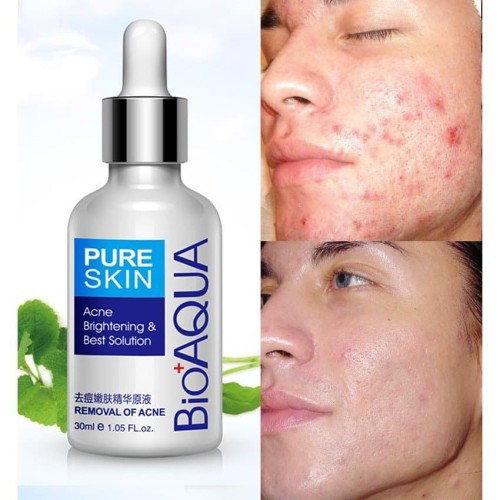 (Hàng Mới Về) Serum Trị Sẹo Mụn 30ml Bioaqua Cao Cấp