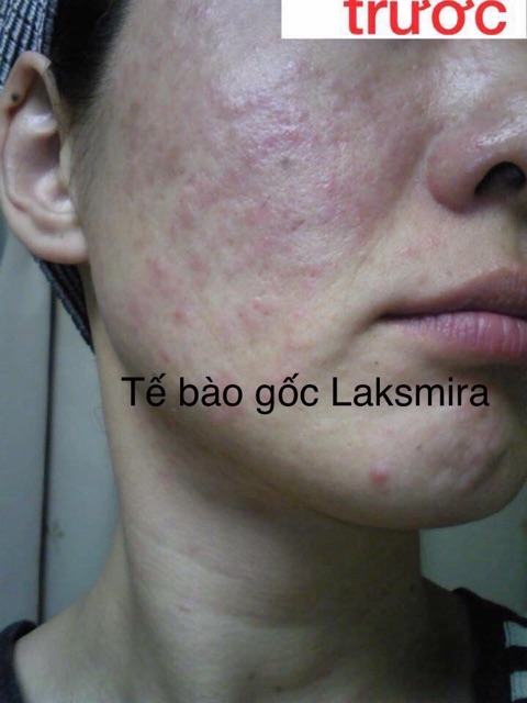 ( Mẫu Mới 2019 ) TẾ BÀO GỐC LAKSMIRA STEM CELL SOLUTION ( Lẻ 1 ống )