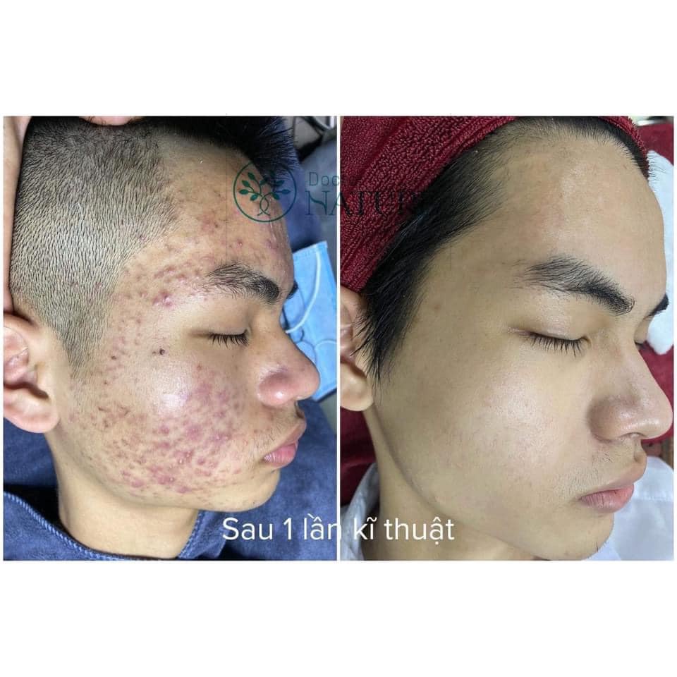 COMBO  MỤN DOCTOR NATURE
