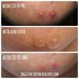 MIẾNG DÁN MỤN COSRX ACNE [SET 2 MIẾNG]