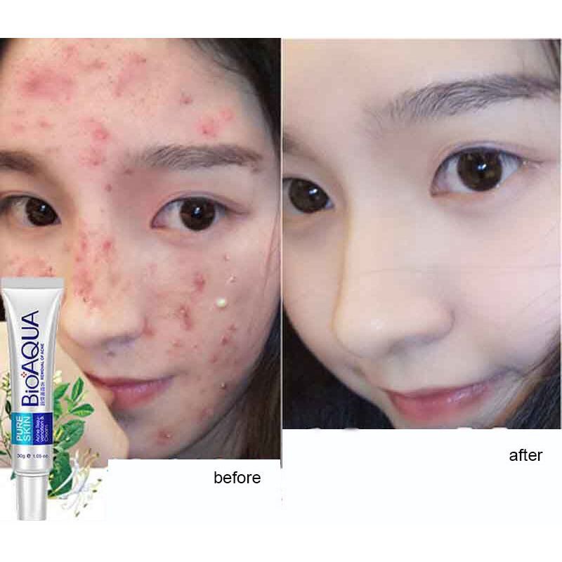 Kem hỗ trợ giảm mụn pure skin BIOAQUA 30g