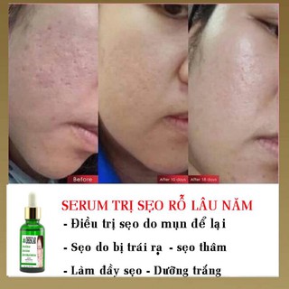 SERUM OHISCAR XÓA SẸO RỖ SẸO MỤN LÂU NĂM