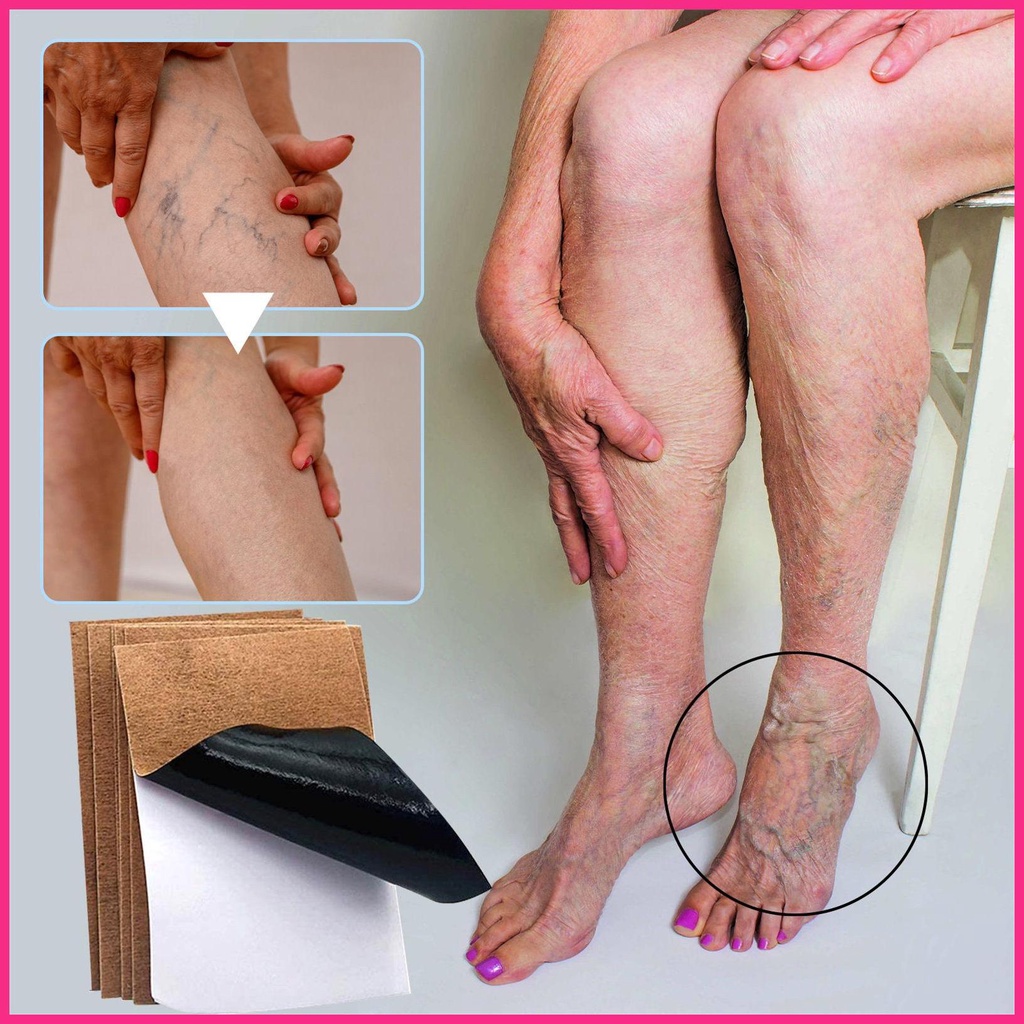 Bộ 12 Miếng Dán Trị Giãn Tĩnh Mạch Cao Cấp Chuyên Dụng