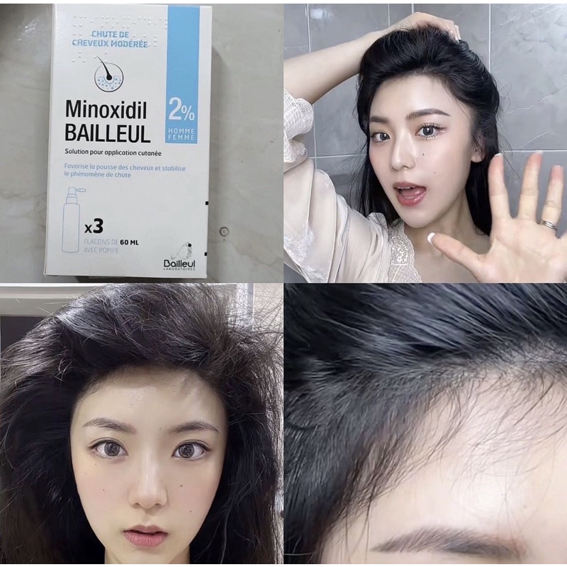 Xịt mọc tóc Minoxidil Bailleul