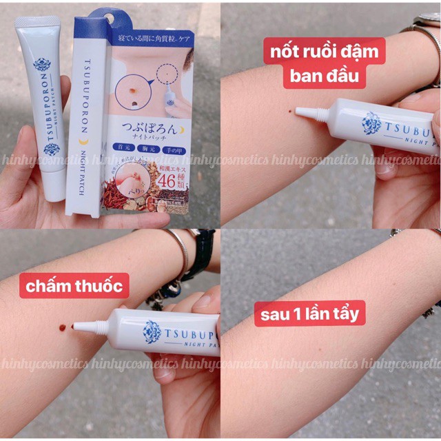 KEM TẨY NỐT RUỒI TSUBUPORON NIGHT PATCH Nhật Bản