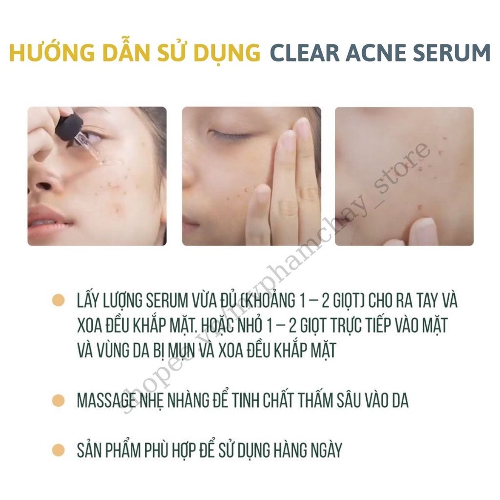 Tinh Chất Serum Hết Mụn-Làm Mờ Vết Thâm Sẹo-Se Khít Lỗ Chân Lông- Ngăn Ngừa Mụn Tái Phát  Clear Acne Quyên Lara 12Ml