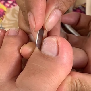 Bộ dao lấy khóe móng