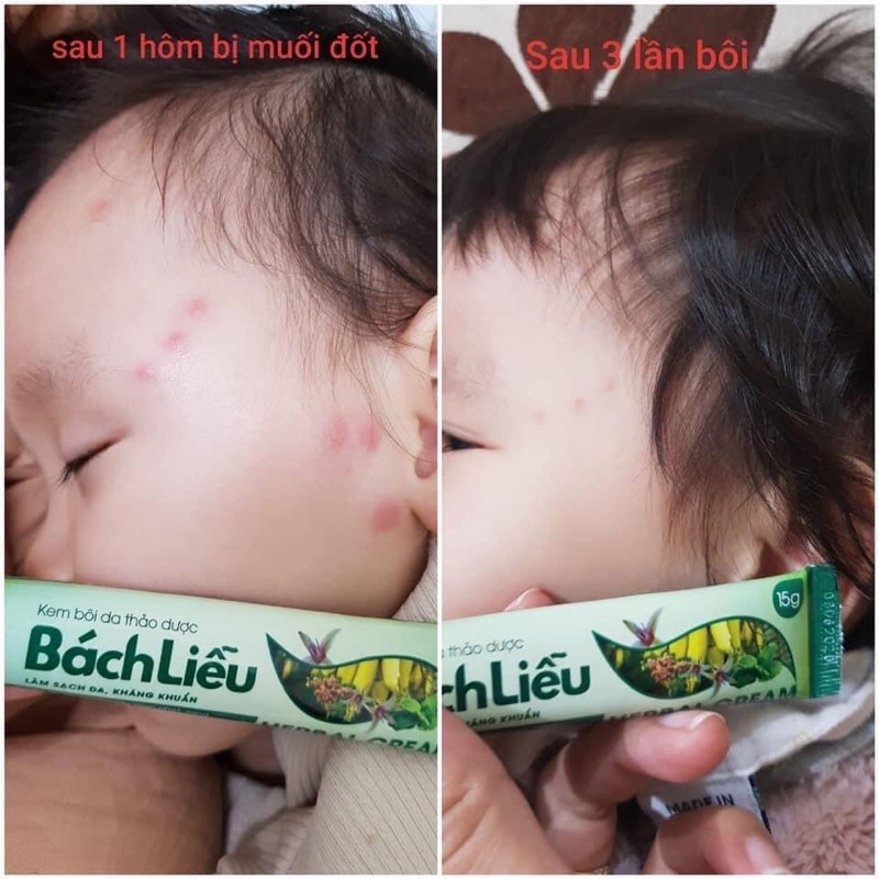 Kem bôi da thảo dược Bách Liễu