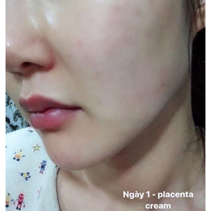 Kem Nhau Thai Vạn Năng Celes Placentary Cream