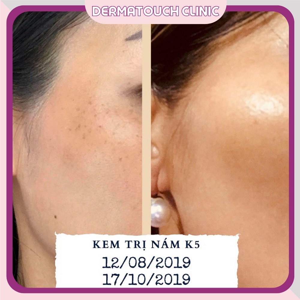 Kem Nám K5 Cryolaser hỗ trợ giảm nám, tàn nhang, dùng cho da nhạy cảm, da sau laser