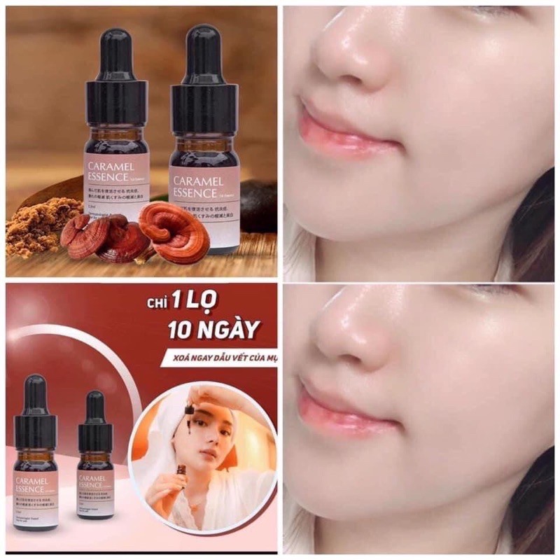 [mua 2 tặng 1] Serum Caramel Essence Ngừa Mụn Xoá Thâm 5ml